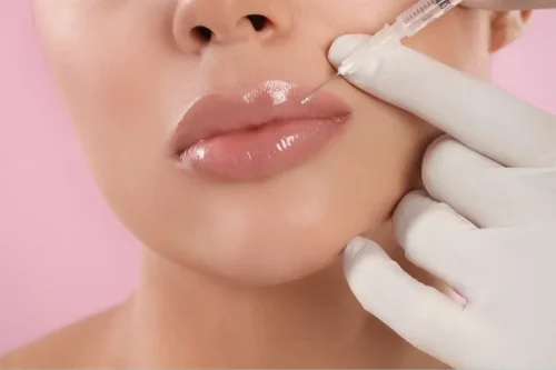 همه چیز درباره تزریق فیلر لب